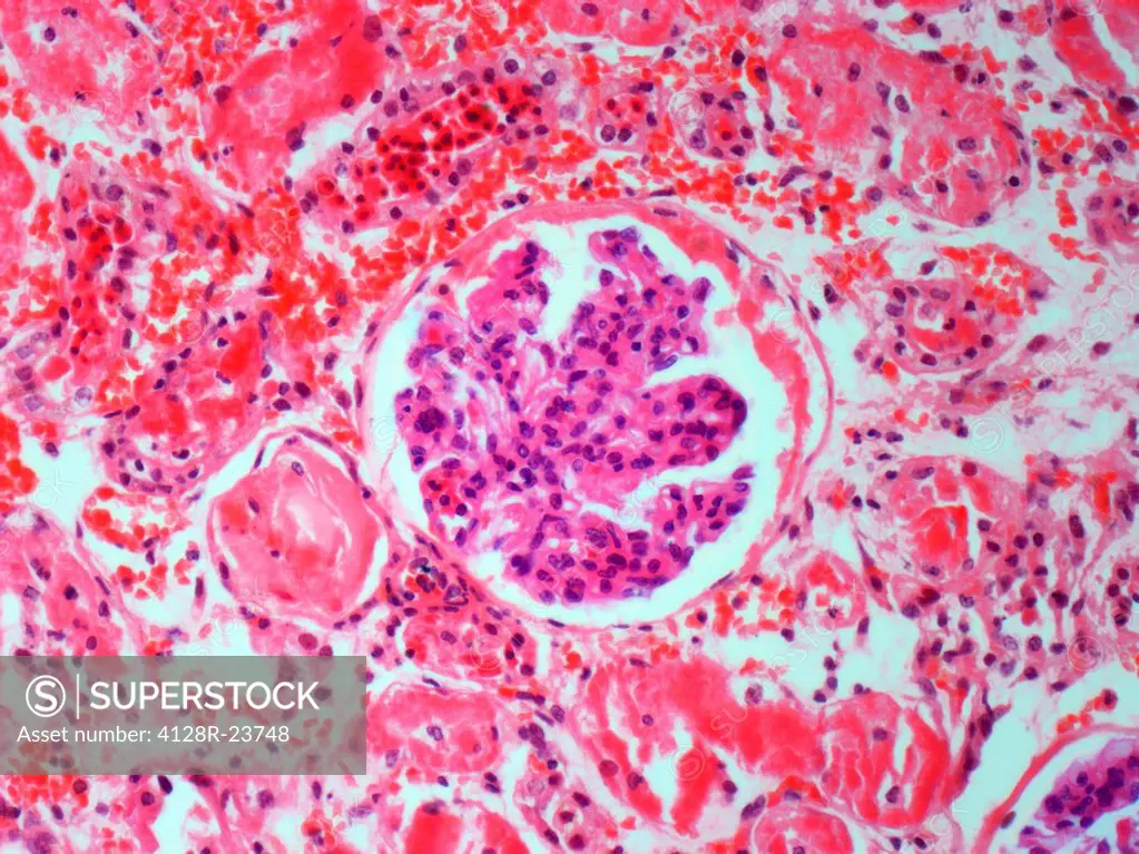 Kidney disease. Light micrograph of a section through an inflamed kidney showing a glomerulus coiled capillaries, purple. It is surrounded by vascular...