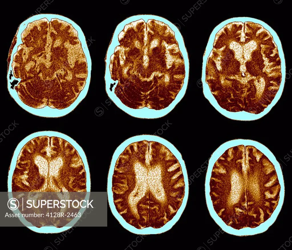Brain with Alzheimer´s disease, CT scan