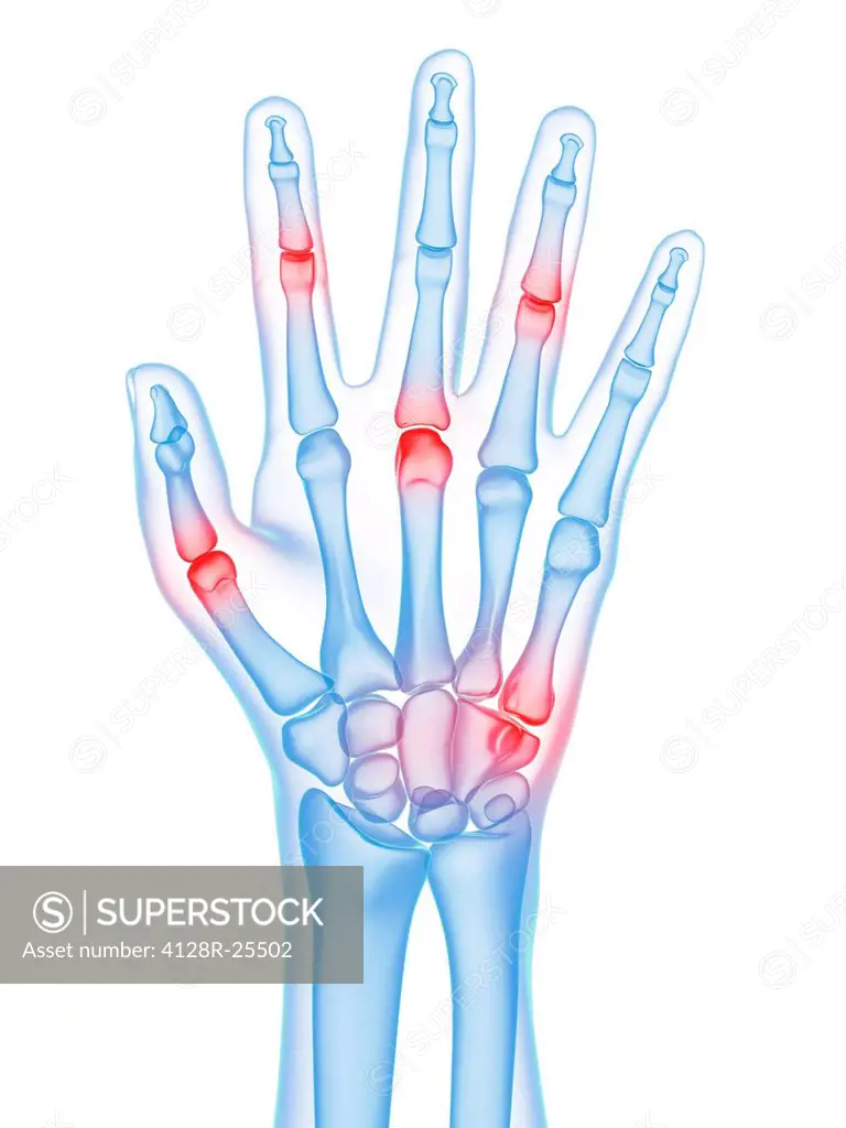 Hand joint pain, conceptual computer artwork.