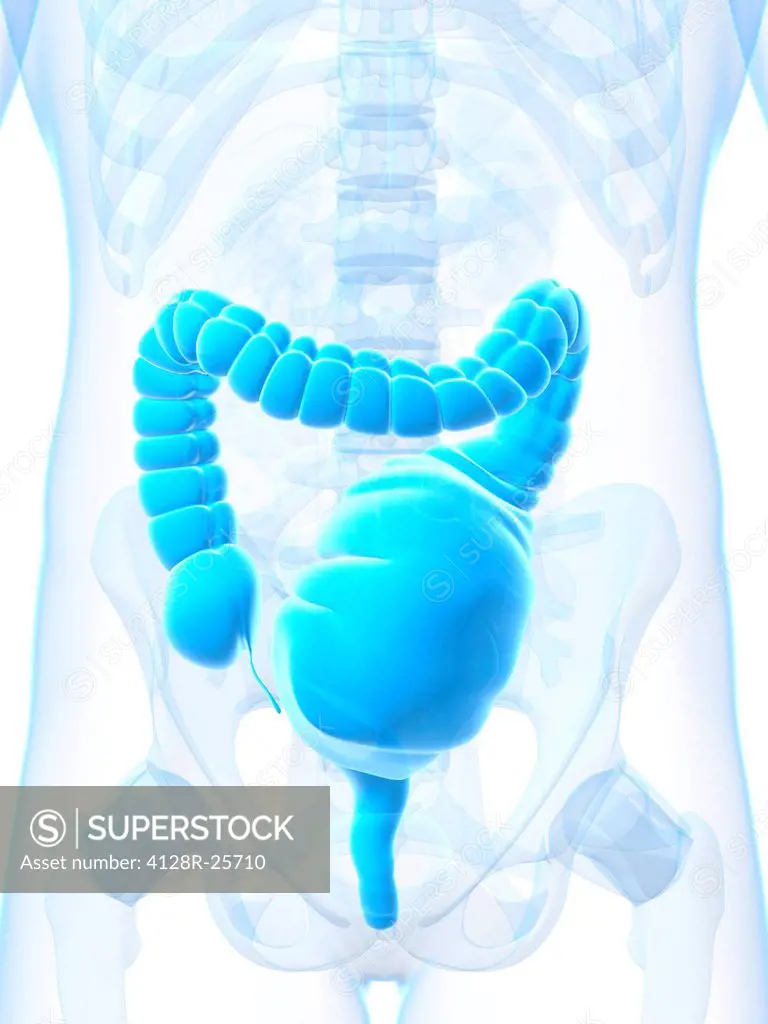 Toxic megacolon, computer artwork. This is an abnormal dilation of the colon caused by inflammatory bowel disease or infection.