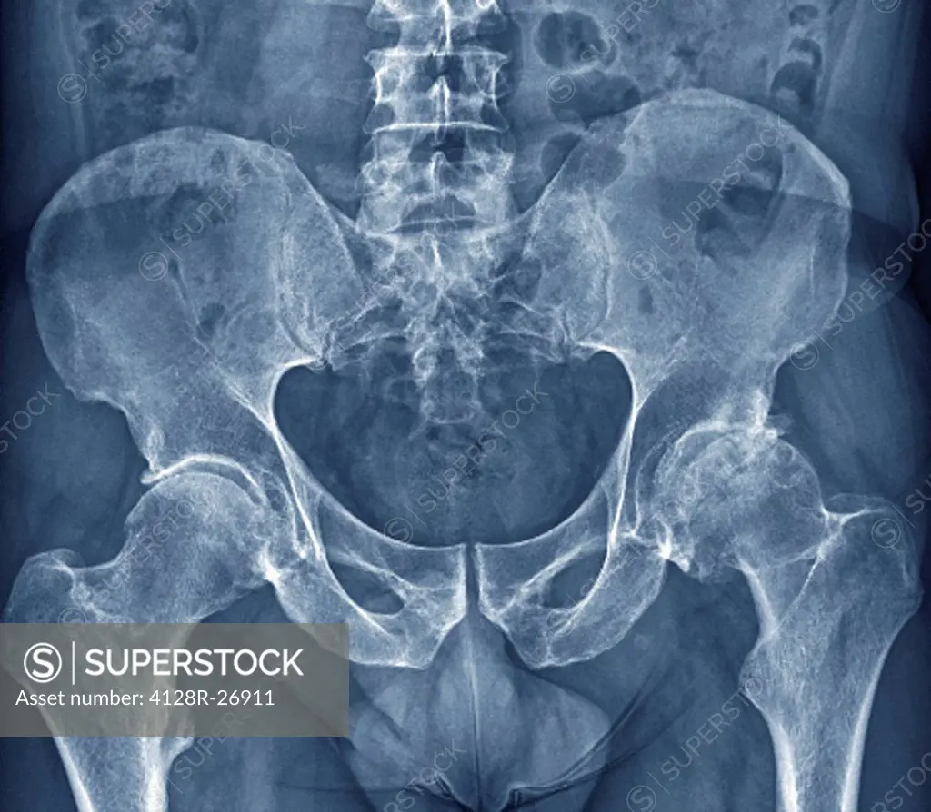 Osteoarthritis of the hip. Coloured frontal X-ray (front view) of the pelvis in a 59 year old patient showing osteoarthritis of both hip joints. The b...