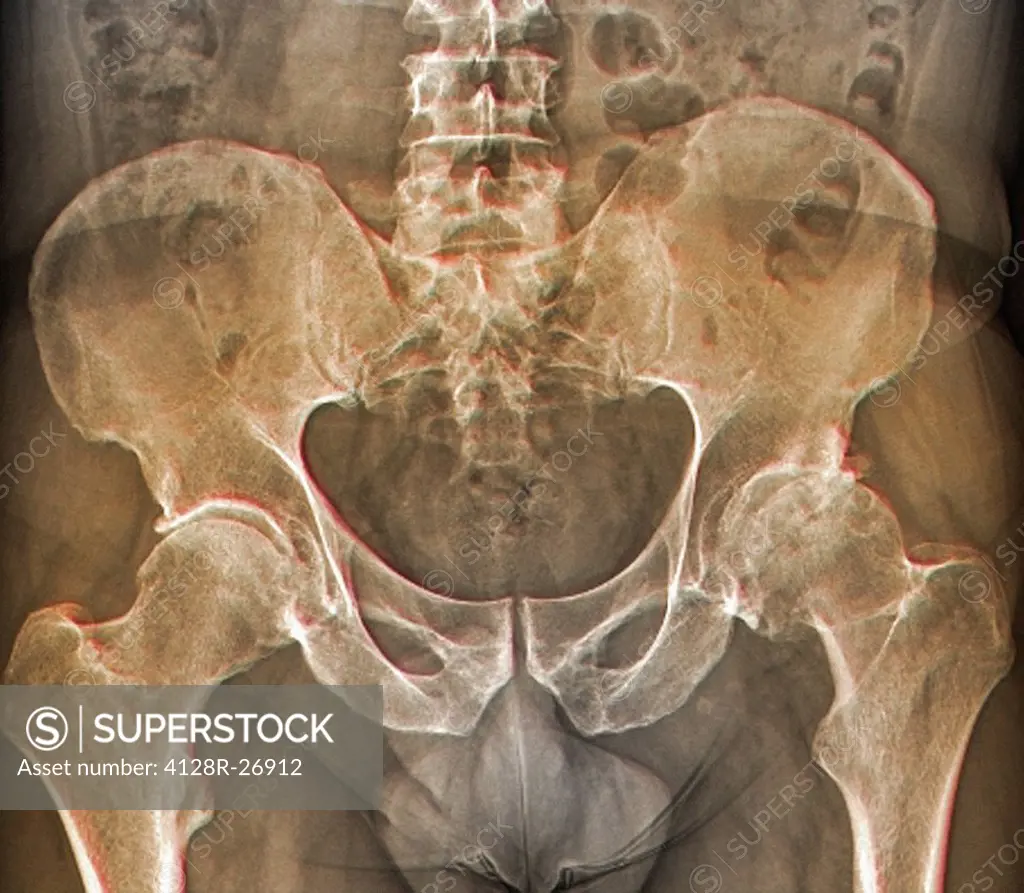 Osteoarthritis of the hip. Coloured frontal X-ray (front view) of the pelvis in a 59 year old patient showing osteoarthritis of both hip joints. The b...