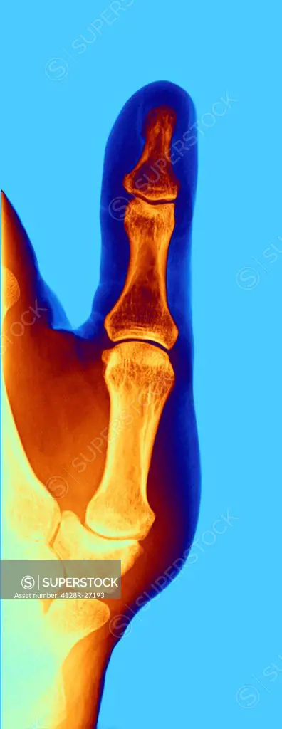 Coloured X-ray of the hand of a patient with arthrosis, particularly the saddle joint. Arthrosis is a degenerative joint disease that damages cartilag...