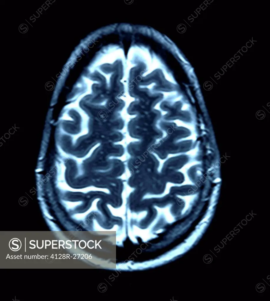 Normal brain. Coloured magnetic resonance imaging (MRI) scan of an axial section through a healthy brain. The front of the brain is towards top of the...