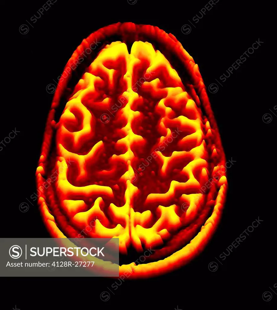 Normal brain. Coloured magnetic resonance imaging (MRI) scan of an axial section through a healthy brain, converted into a heightmap or height field. ...