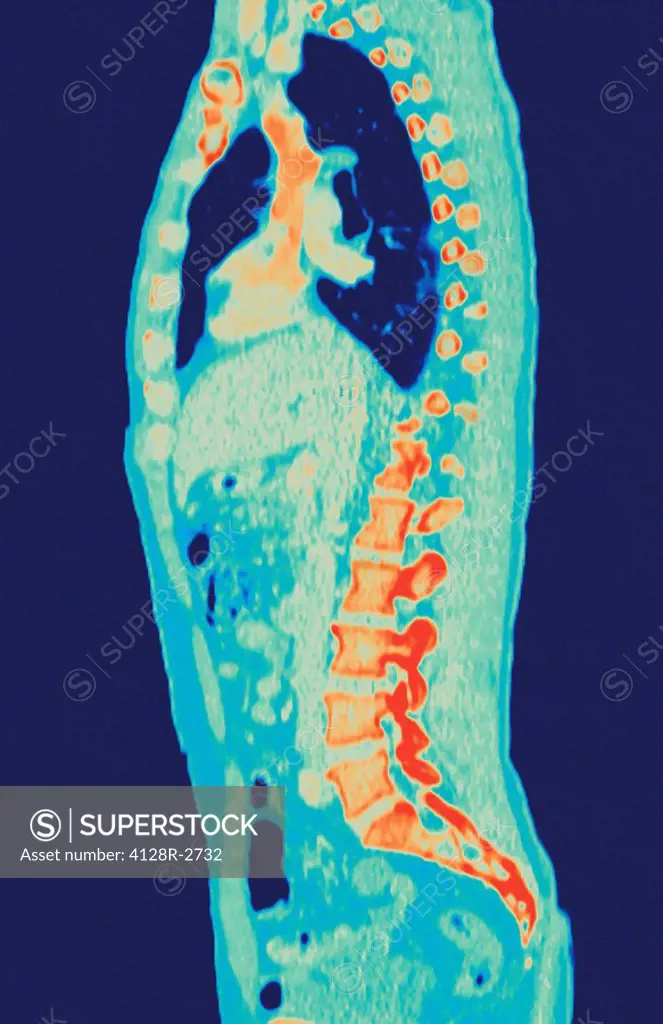 Normal torso, MRI scan