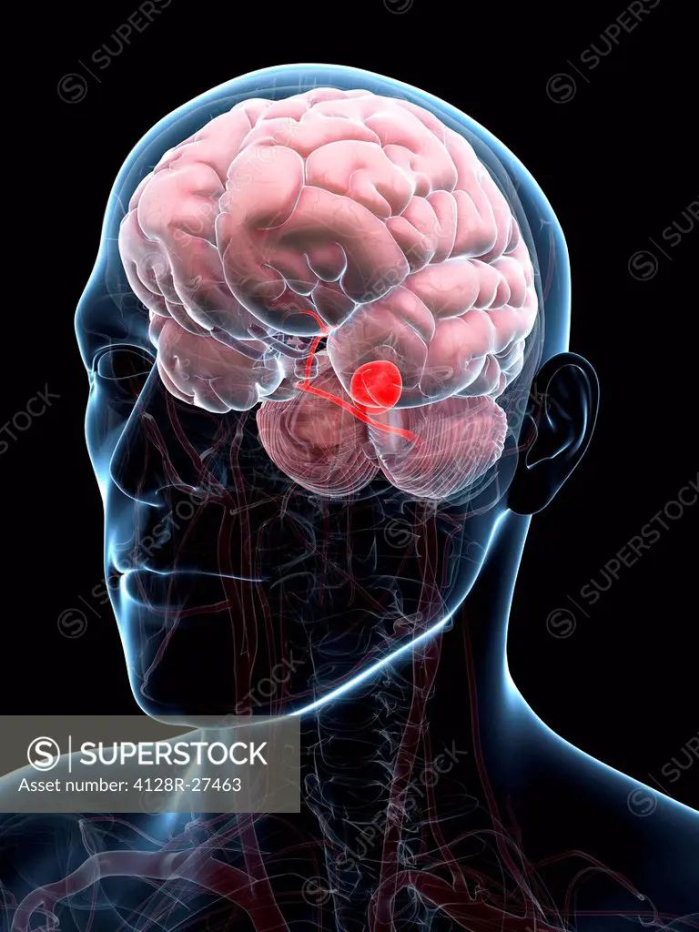 Brain aneurysm, computer artwork.