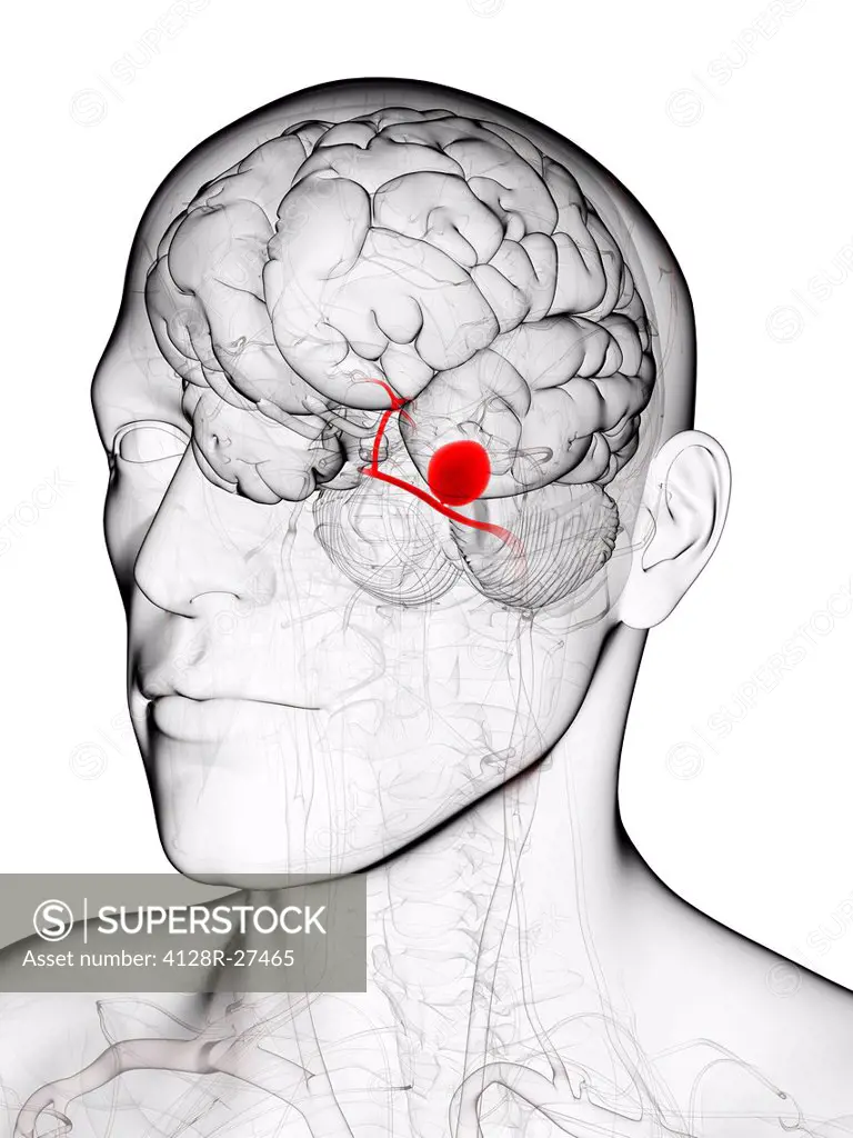 Brain aneurysm, computer artwork.