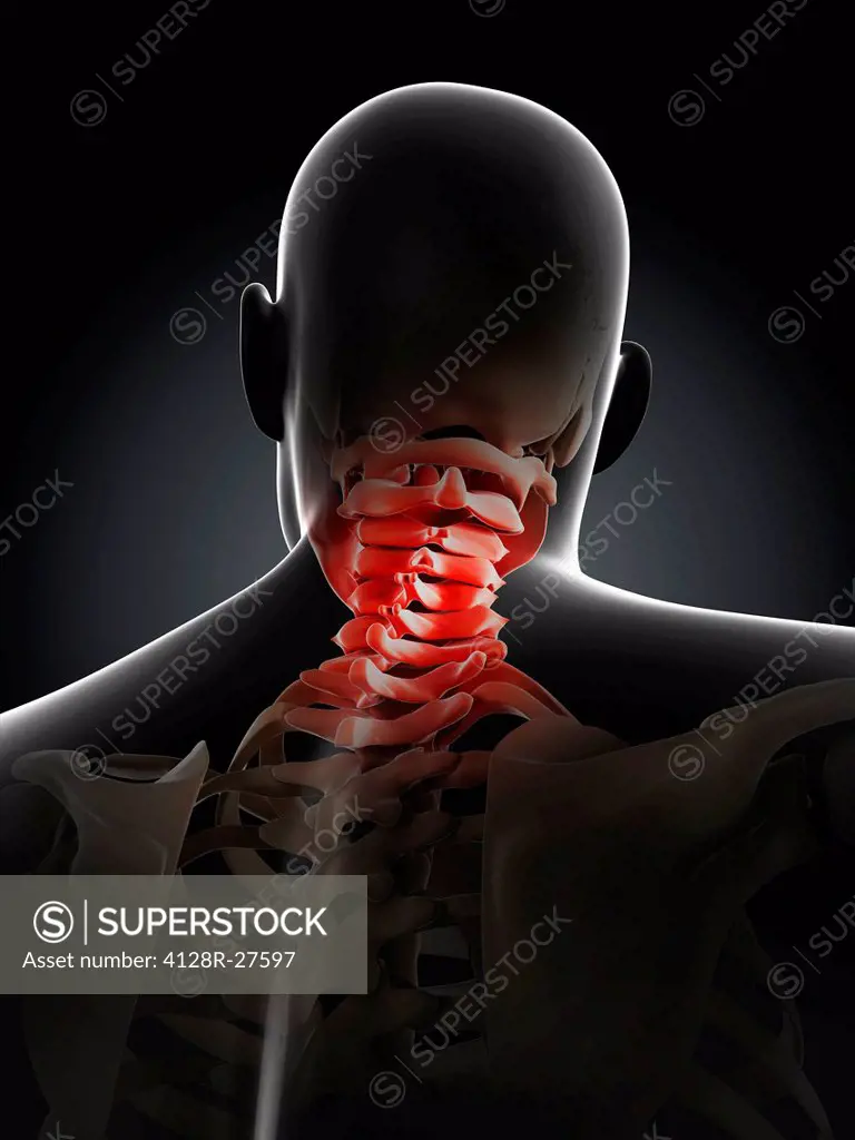 Neck pain, conceptual computer artwork.