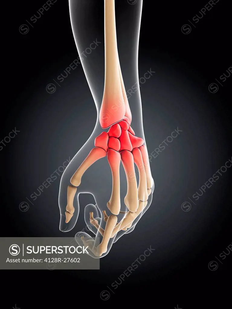 Wrist pain, conceptual computer artwork.