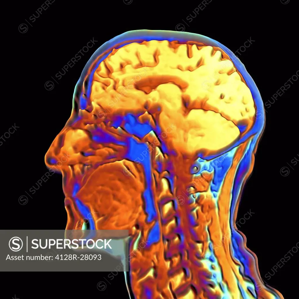 Brain scan. Computer enhanced Magnetic Resonance Imaging (MRI) scan through a human head, showing a healthy brain in side view. The face is seen in pr...