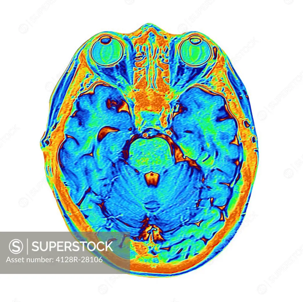 Brain scan. False-colour magnetic resonance imaging (MRI) scan of a human head containing a healthy brain, seen in horizontal view. At upper frame, th...