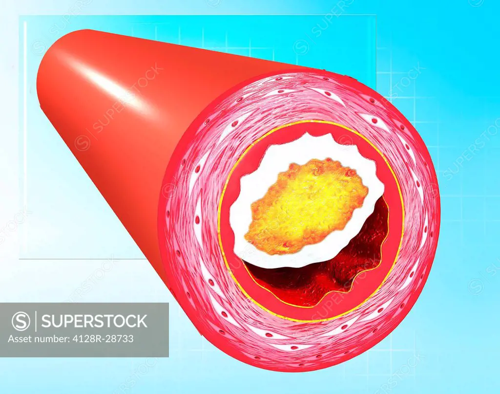 Atherosclerosis. Computer artwork of a narrowed artery, due to a cholesterol plaque.
