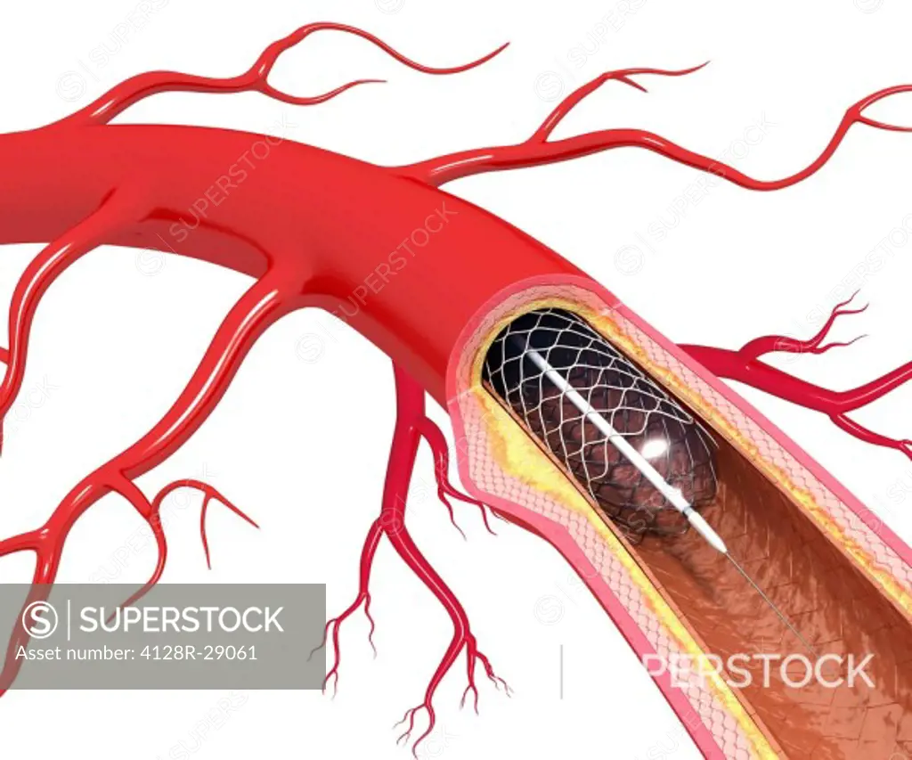 Balloon angioplasty. Computer artwork of a stent being placed in a narrowed blood vessel.