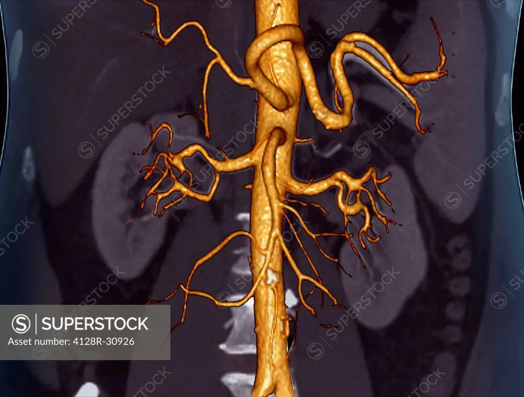 Abdominal aorta. Coloured 3D computed tomography (CT) angiogram of the abdominal aorta of a 53 year old patient. The aorta is the body's main artery. ...