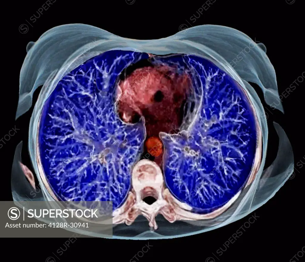Chest anatomy. Coloured 3D computer tomography (CT) scan of a transverse section through the chest of a 54 year old patient. The lungs are blue. At bo...