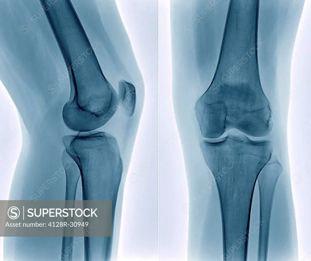 Healthy knee. Coloured frontal (right) and profile (left) X-rays of the healthy knee of a 24 year old patient.