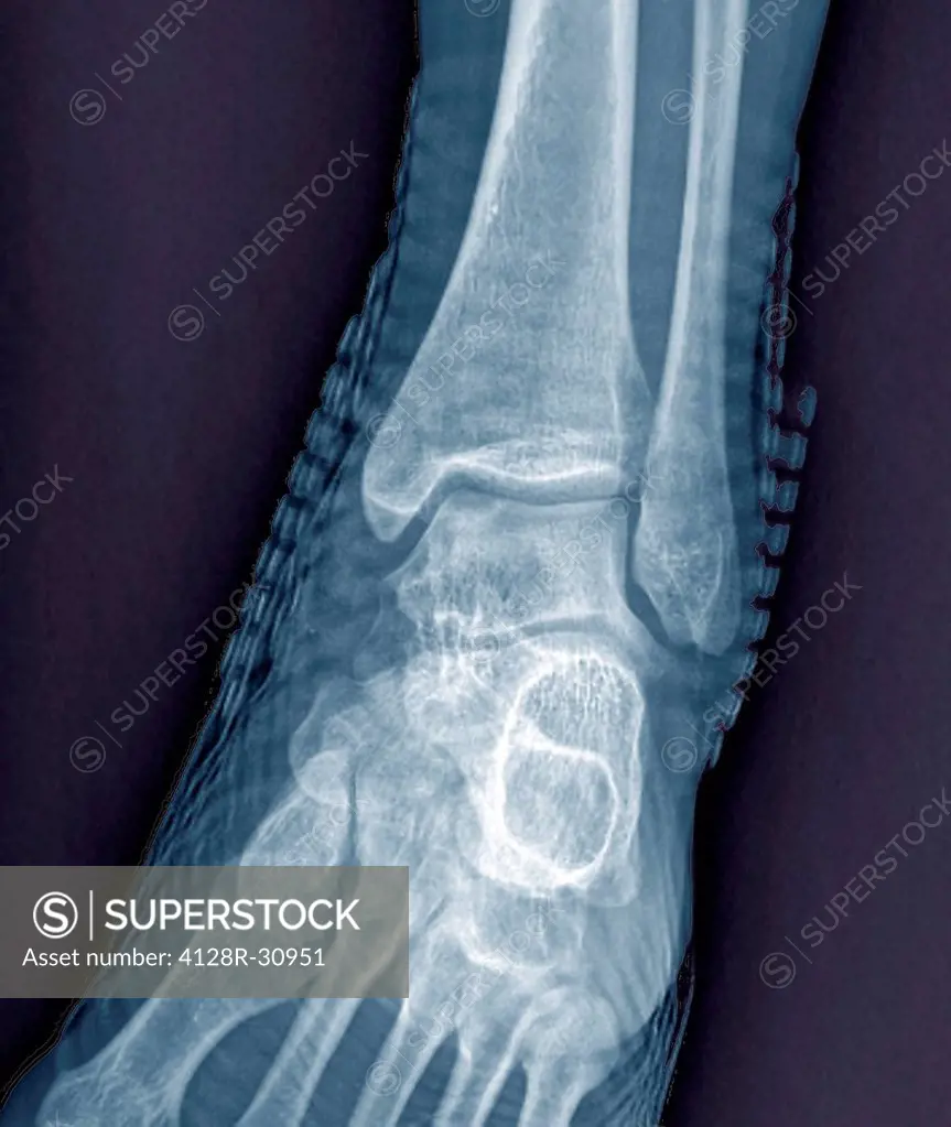 Healthy ankle joint. Coloured frontal X-ray of the left ankle of a 21 year old patient. Strapping around the ankle is visible on this X-ray.