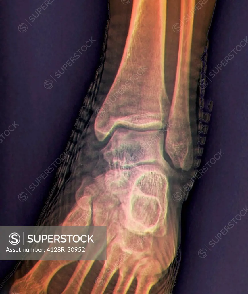 Healthy ankle joint. Coloured frontal X-ray of the left ankle of a 21 year old patient. Strapping around the ankle is visible on this X-ray.