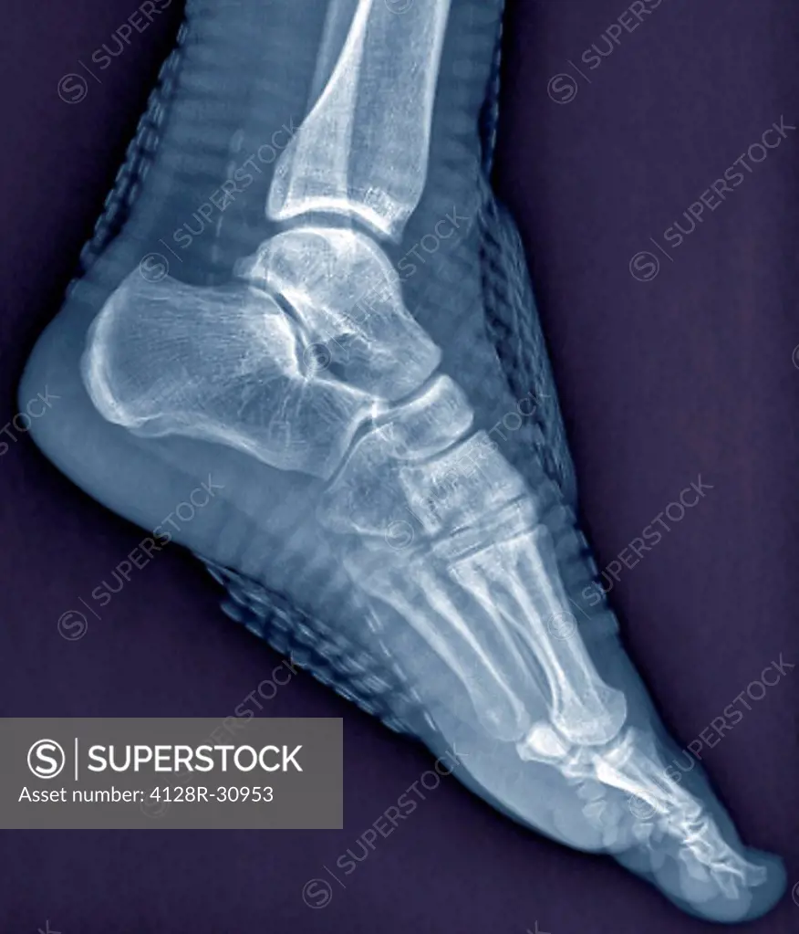 Healthy ankle joint. Coloured profile X-ray of the left ankle of a 21 year old patient. Strapping around the ankle is visible on this X-ray.