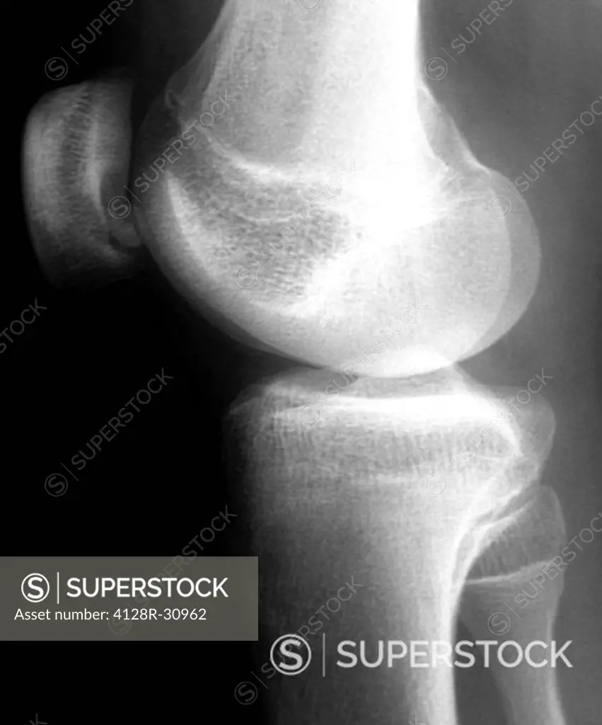 Knee disease. X-ray of the right knee of an 18 year old patient with osteochondritis dissecans (OCD) of the knee. A small piece of bone and cartilage ...