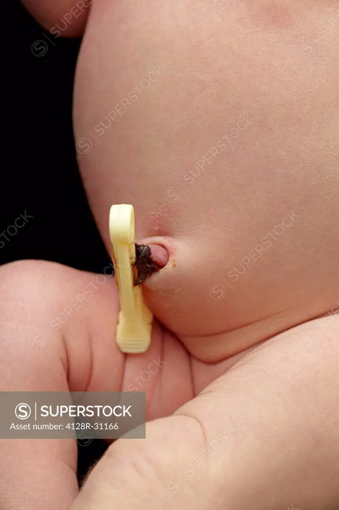 Umbilical cord clip on a 4 day old baby.