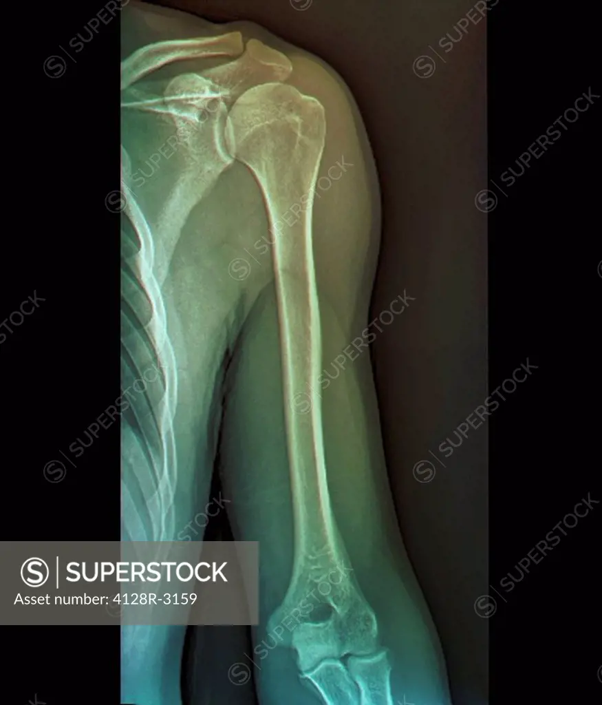 Normal shoulder joint, X_ray