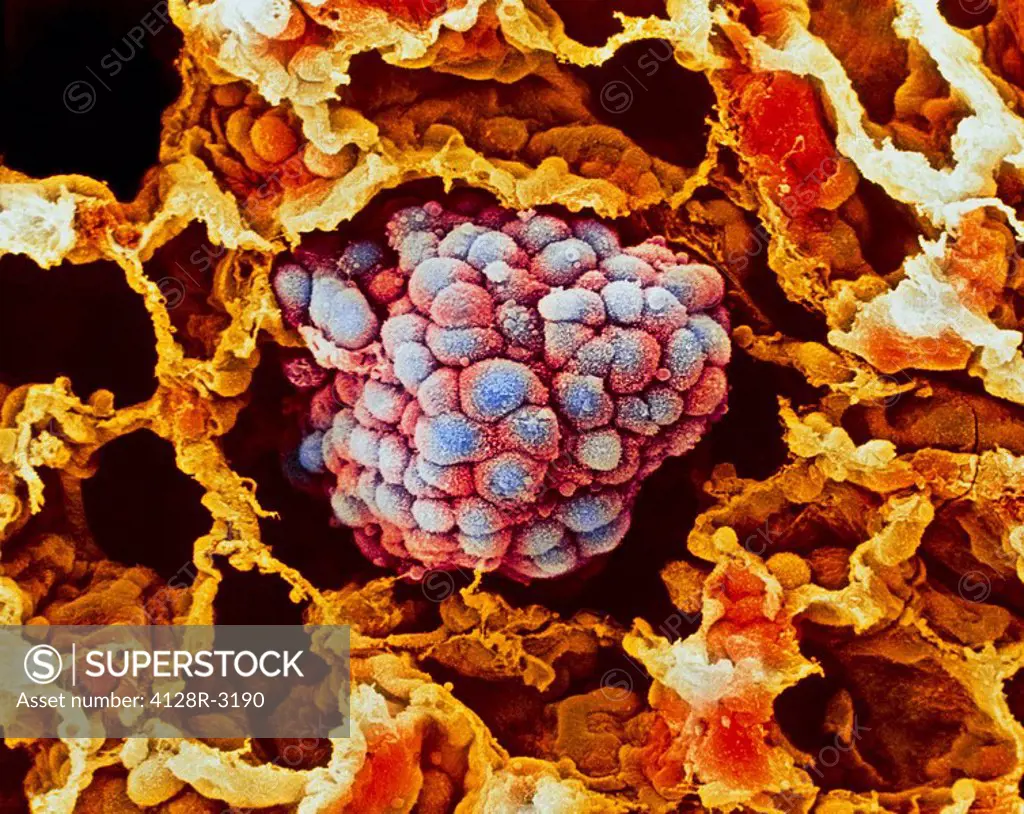 Coloured SEM of a cancerous tumour in the lung