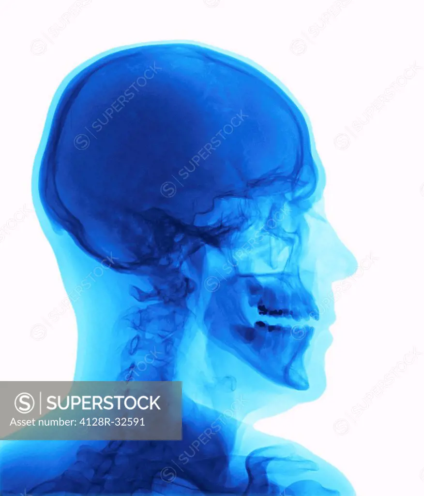 Human head. X-ray of a human head in profile, showing the bones and structures of the neck, cranium and face. Also seen are the teeth, jaw bones, and ...