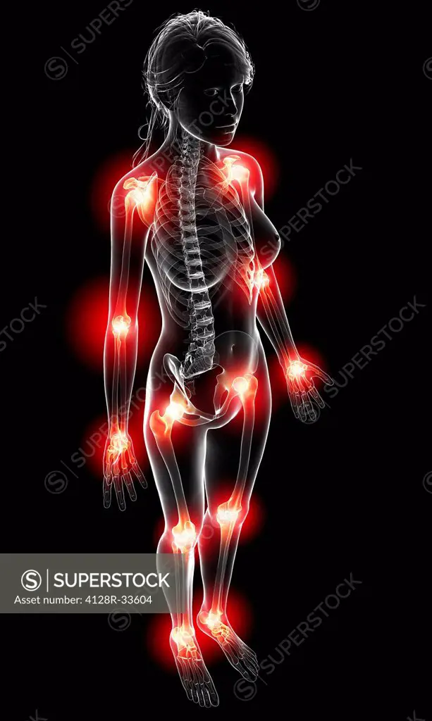 Joint pain, computer artwork.