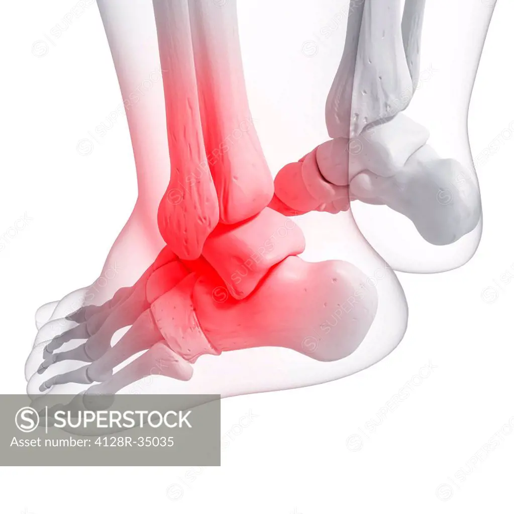 Foot pain, computer artwork.