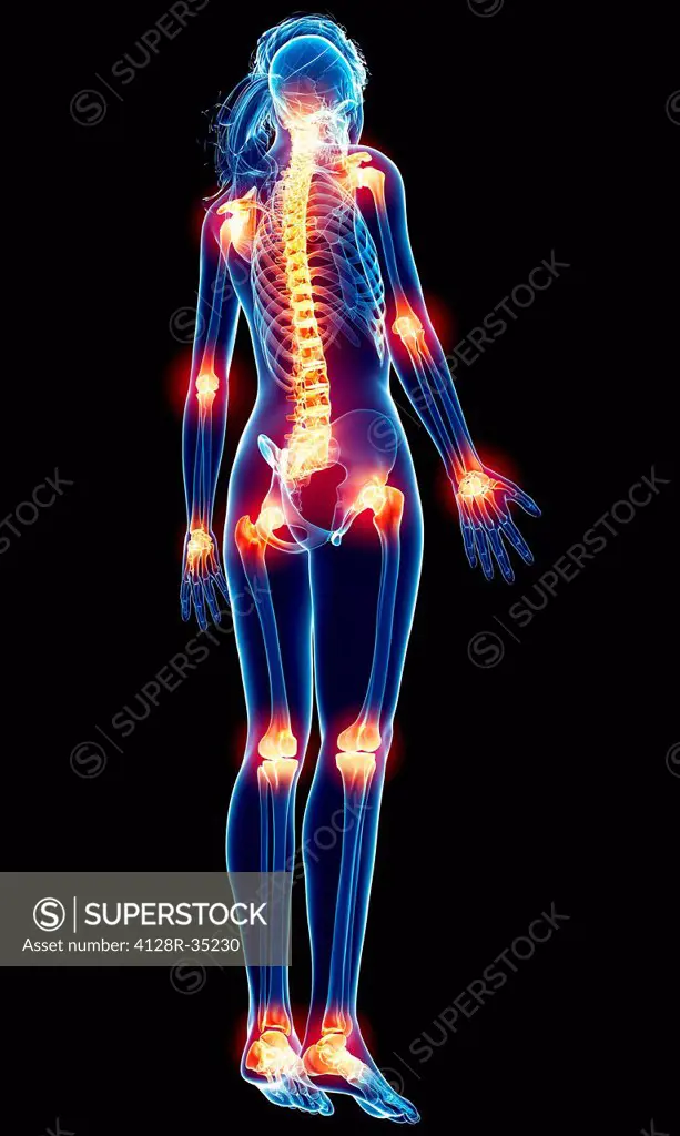 Joint pain, computer artwork.