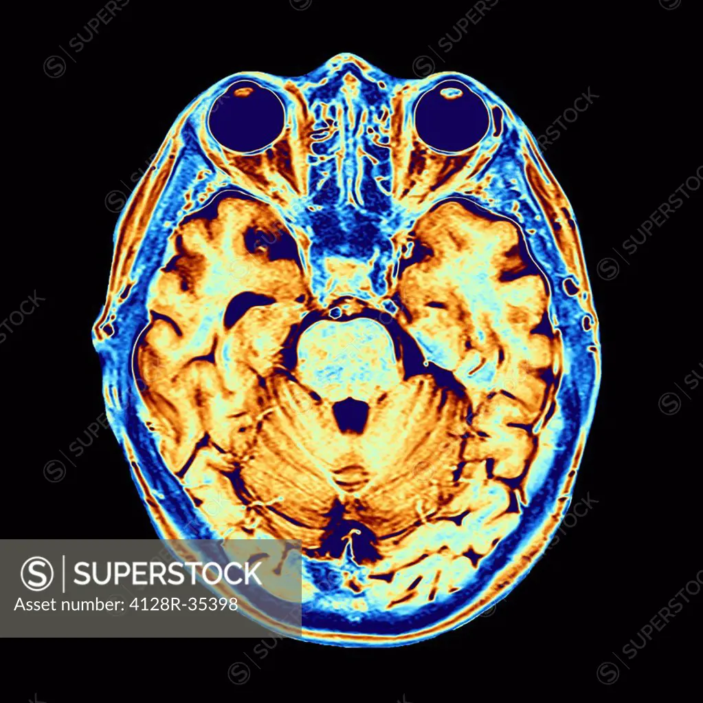 Brain scan. False-colour magnetic resonance imaging (MRI) scan of a human head containing a healthy brain, seen in horizontal view. At upper frame, th...