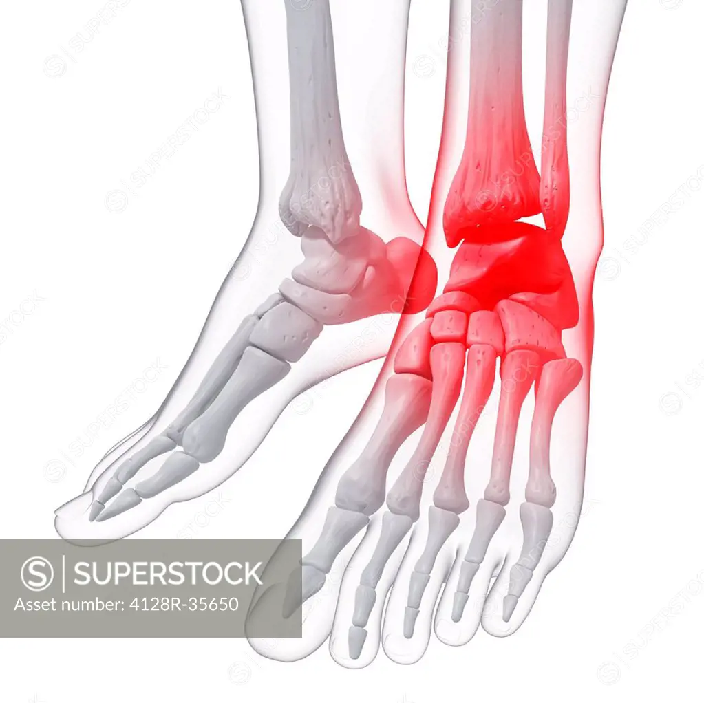Ankle pain, computer artwork.