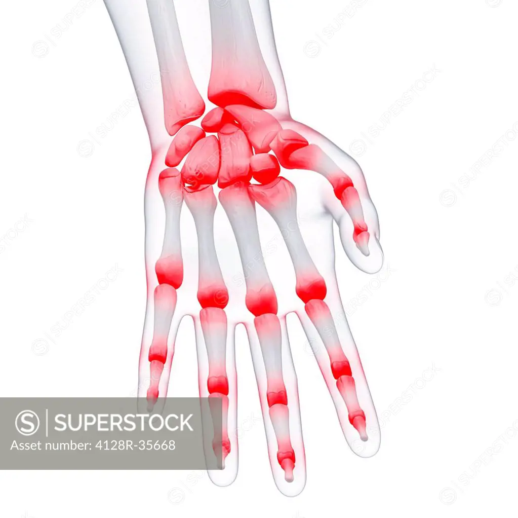 Hand pain, computer artwork.