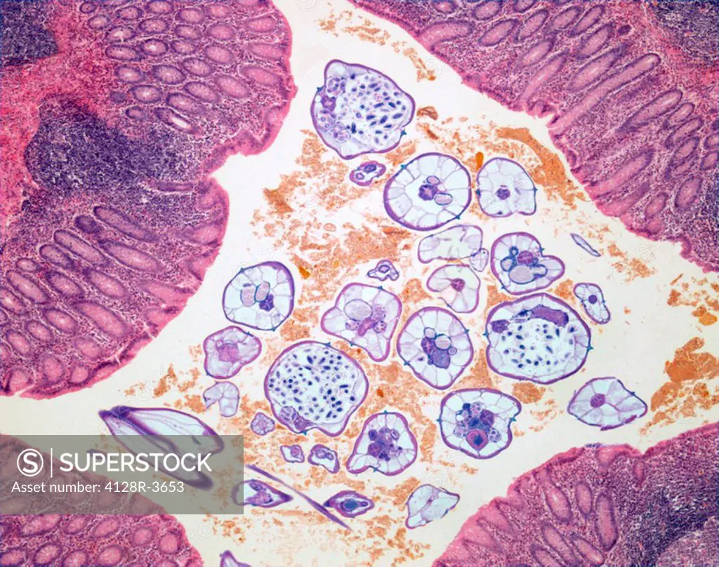 Nematode infection. Light micrograph of a section through a stomach infected with parasitic nematode worms purple. Food debris orange is also seen. Ma...