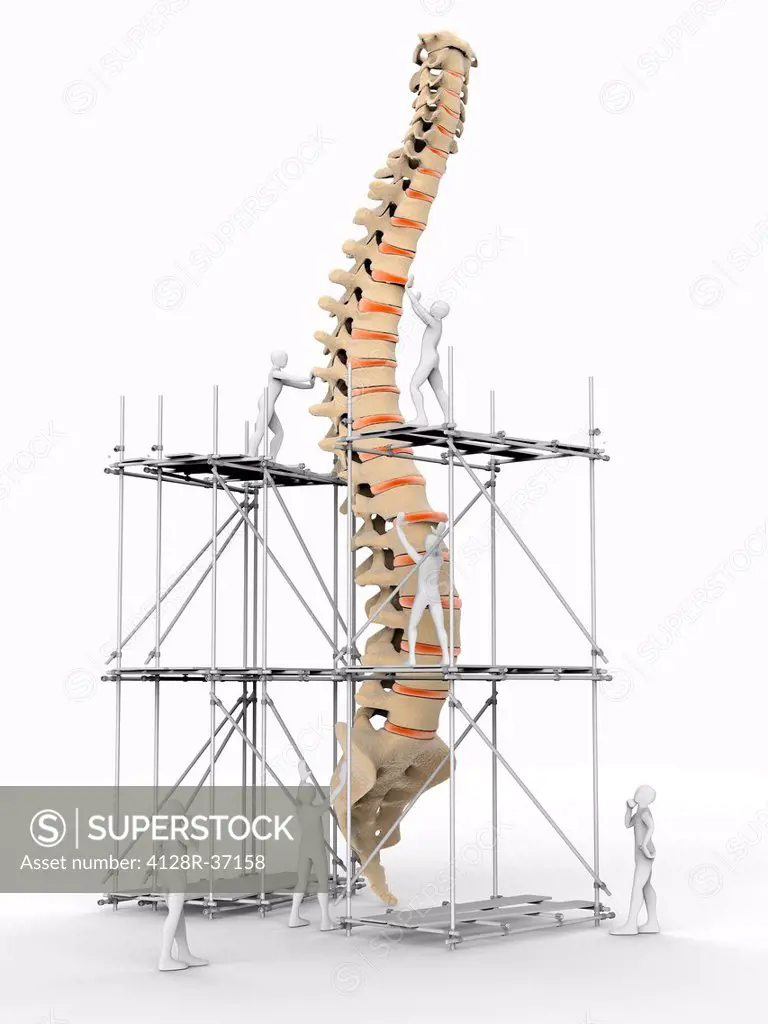 Conceptual computer artwork depicting a spine being repaired.