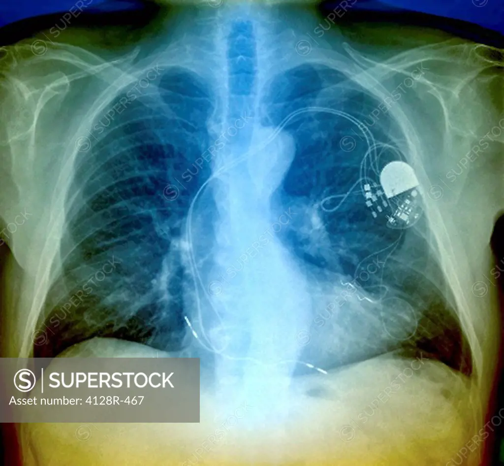 Heart pacemaker, X_ray