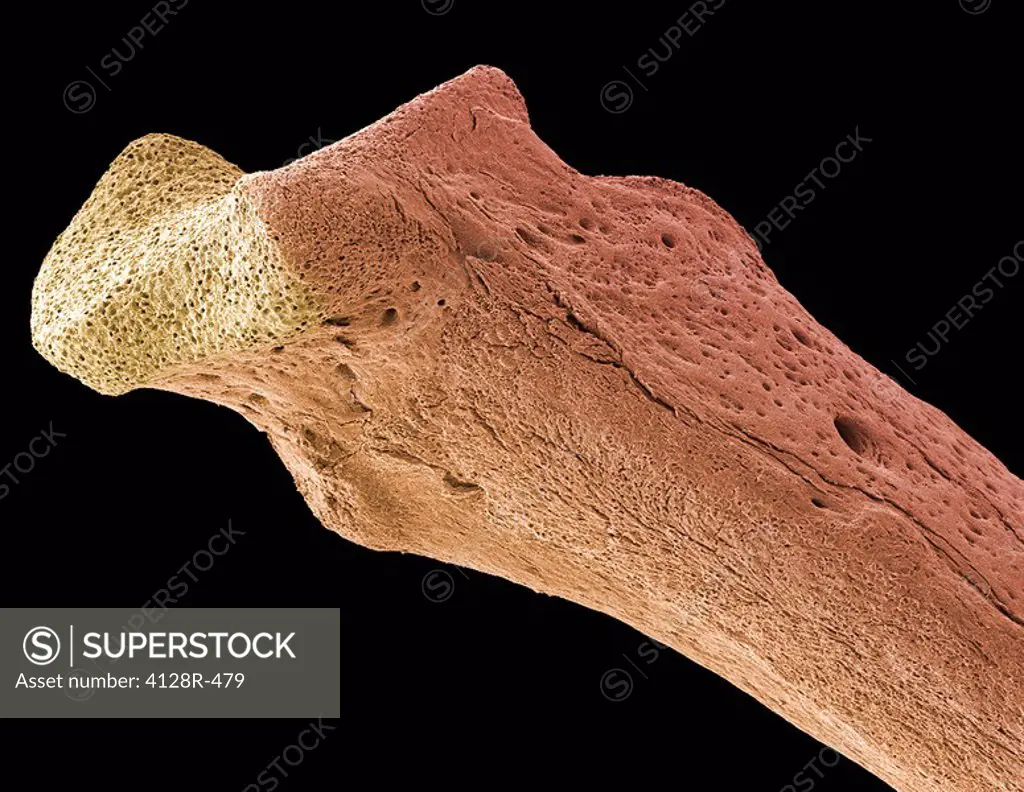 Osteoporotic bone, SEM