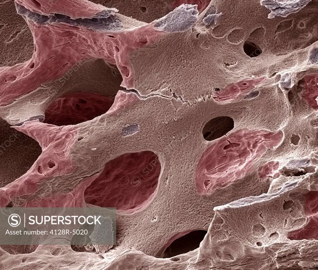 Osteoporotic bone, SEM