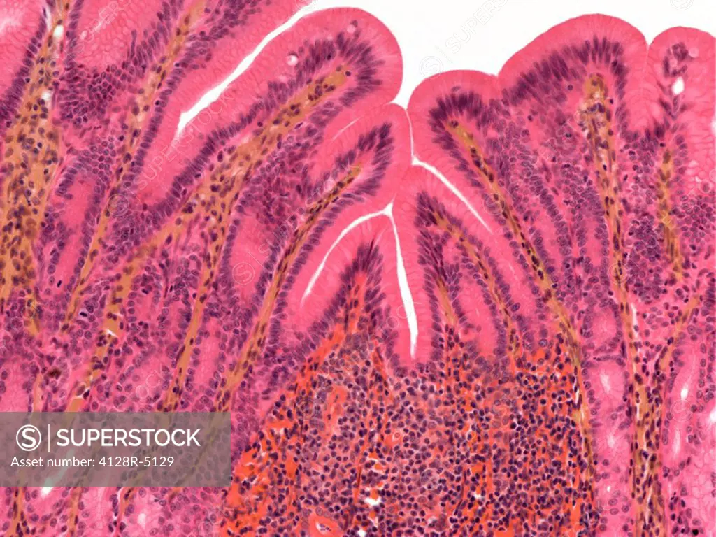 Stomach lining, light micrograph. The stomach lumen is lined by mucous cells. At bottom centre is an accumulation of lymphocytes forming a lymphatic n...