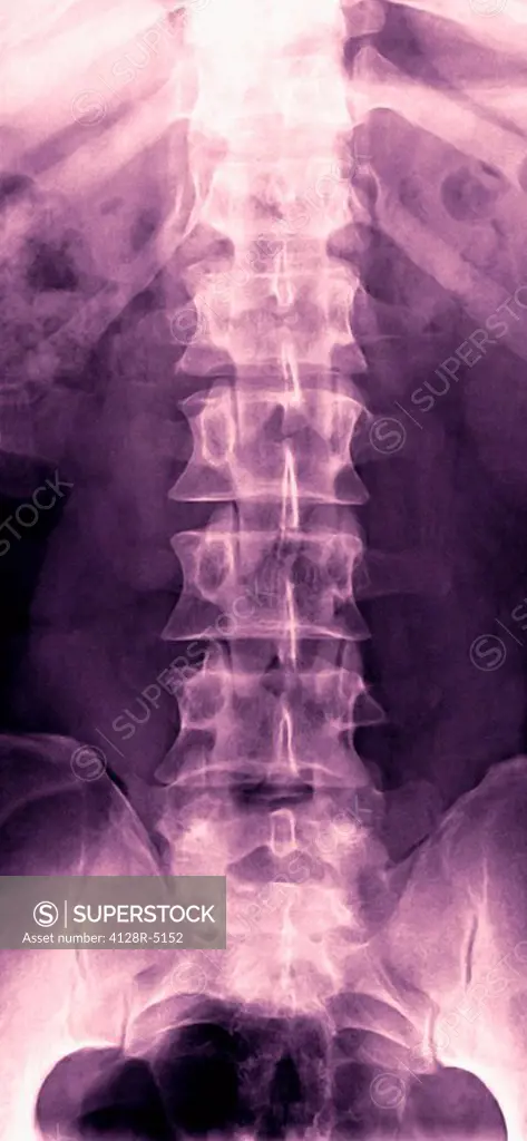 Normal lumbar spine, X_ray