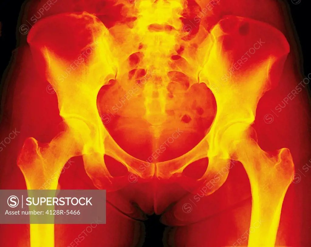 Normal female pelvis, X_ray