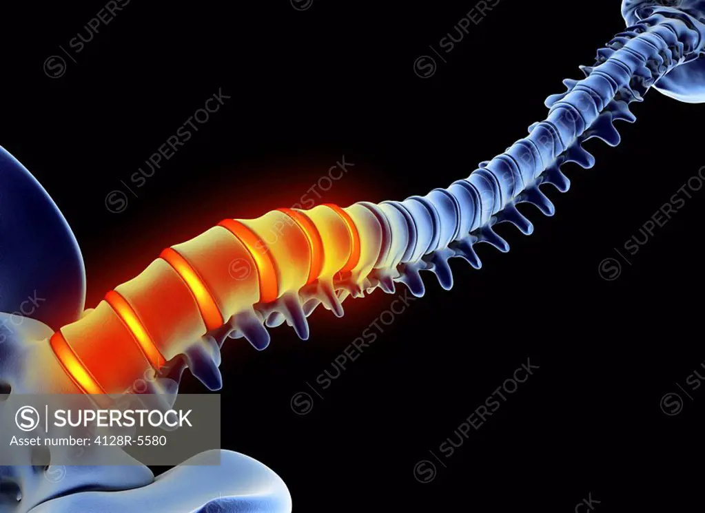 Computer artwork depicting back pain red_orange. Shown is the human spine emphasizing the lumbar vertebrae. The sacrum is just visible in the lower le...
