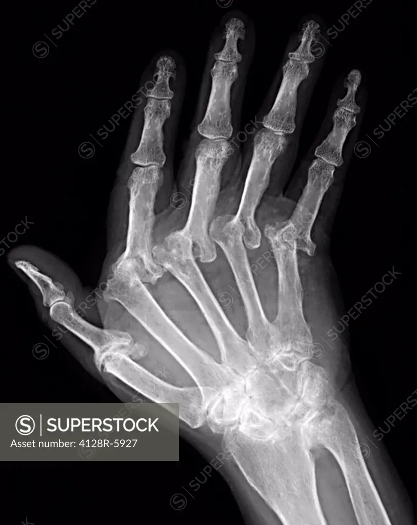 Arthritic hand, X_ray
