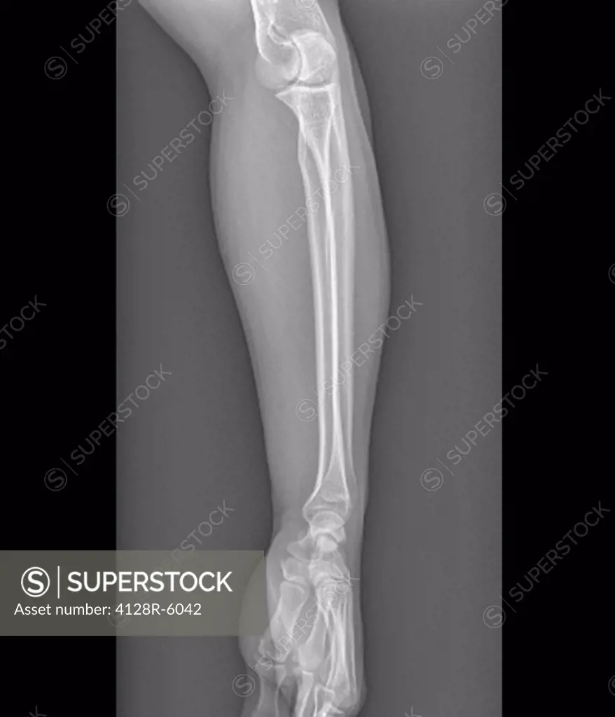 Normal elbow and wrist joints, X_ray