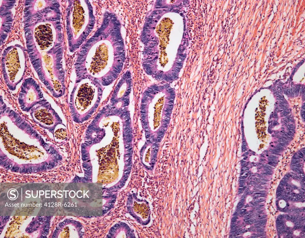 Colon cancer. Light micrograph of an adenocarcinoma of the colon. The tumour cells have made several acini containing mucinous material and inflammato...