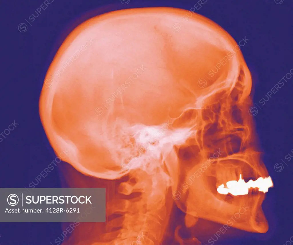 Normal skull, X_ray