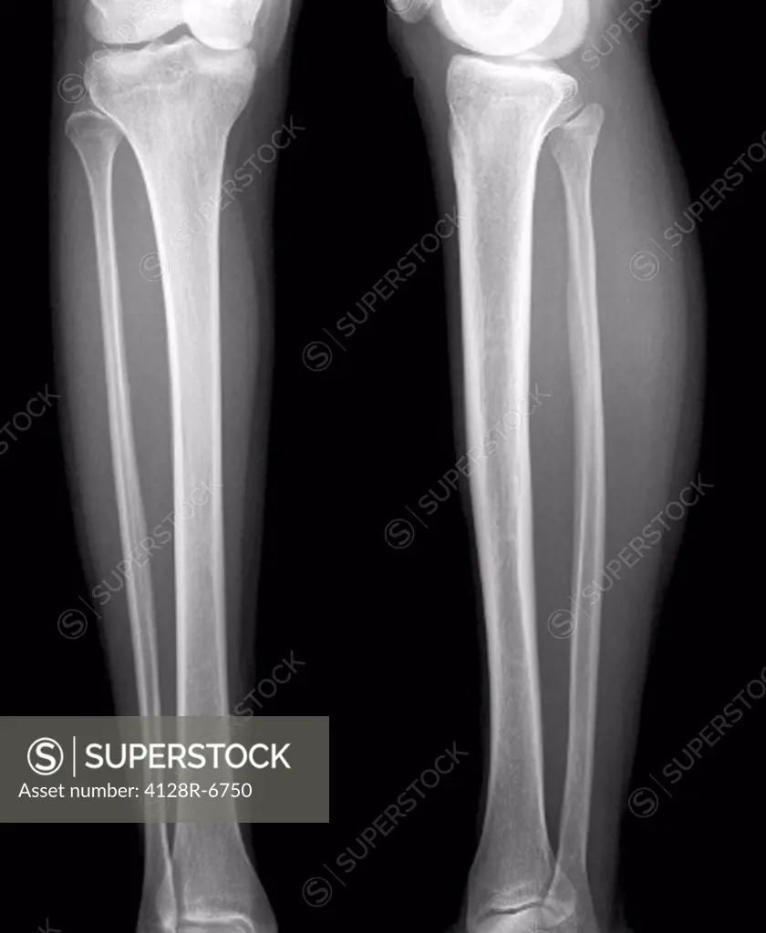 Normal lower legs, X_ray