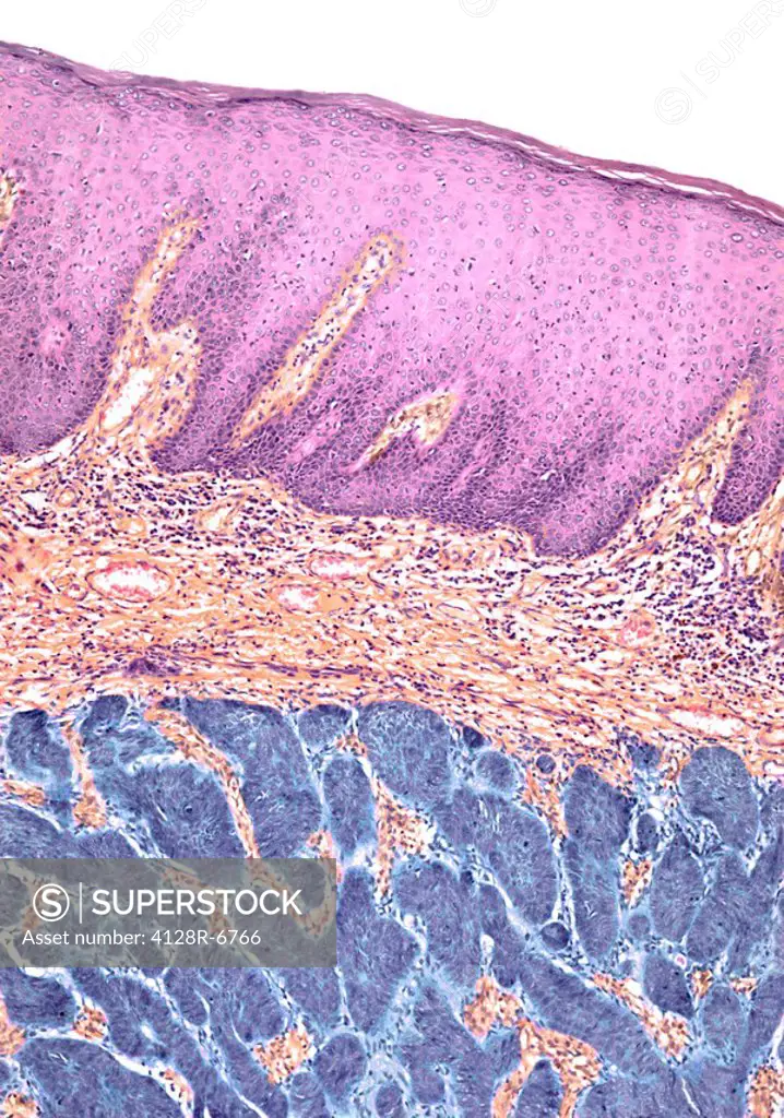 Skin cancer. Light micrograph of a section through a basal cell carcinoma, also known as a rodent ulcer. Large numbers of neoplastic cells blue have i...